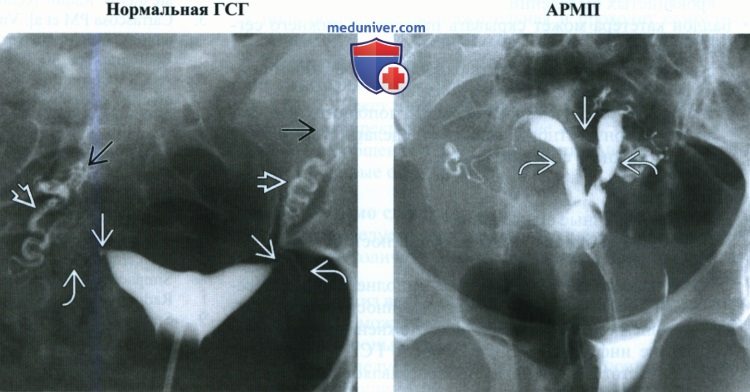Гистеросальпингография показания противопоказания методика. На какой цикл делают гсг. На какой цикл делают гсг. Ультразвуковое исследование прохождения маточных труб. На какой цикл делают гсг.